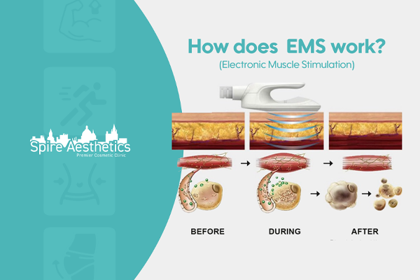 EMS treatment for post pregnancy weight loss treatment Dysart