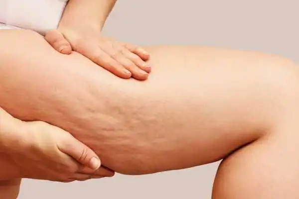 Image of woman showing leg with cellulite Dysart