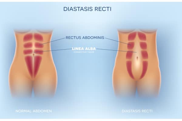 What Non-Surgical Options Are Available for Diastasis Recti Dysart?