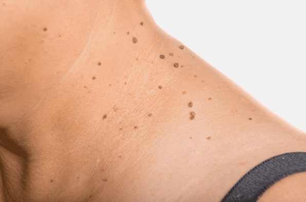 Are you looking for easy skin tag removal Dysart - then contact Spire today!