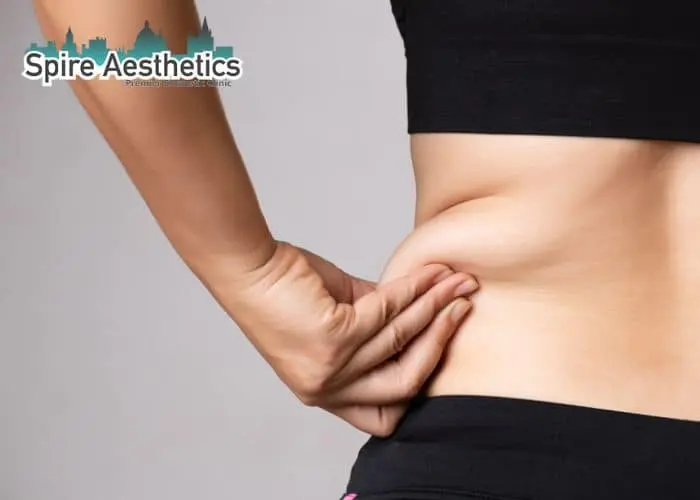 Image of woman pinching fat on their hips Dysart. Fat Freezing treatment