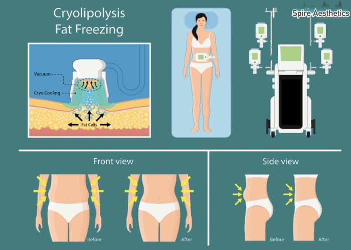 Image of diet and fat freezing combined for best results for Spire Aesthetics Dysart
